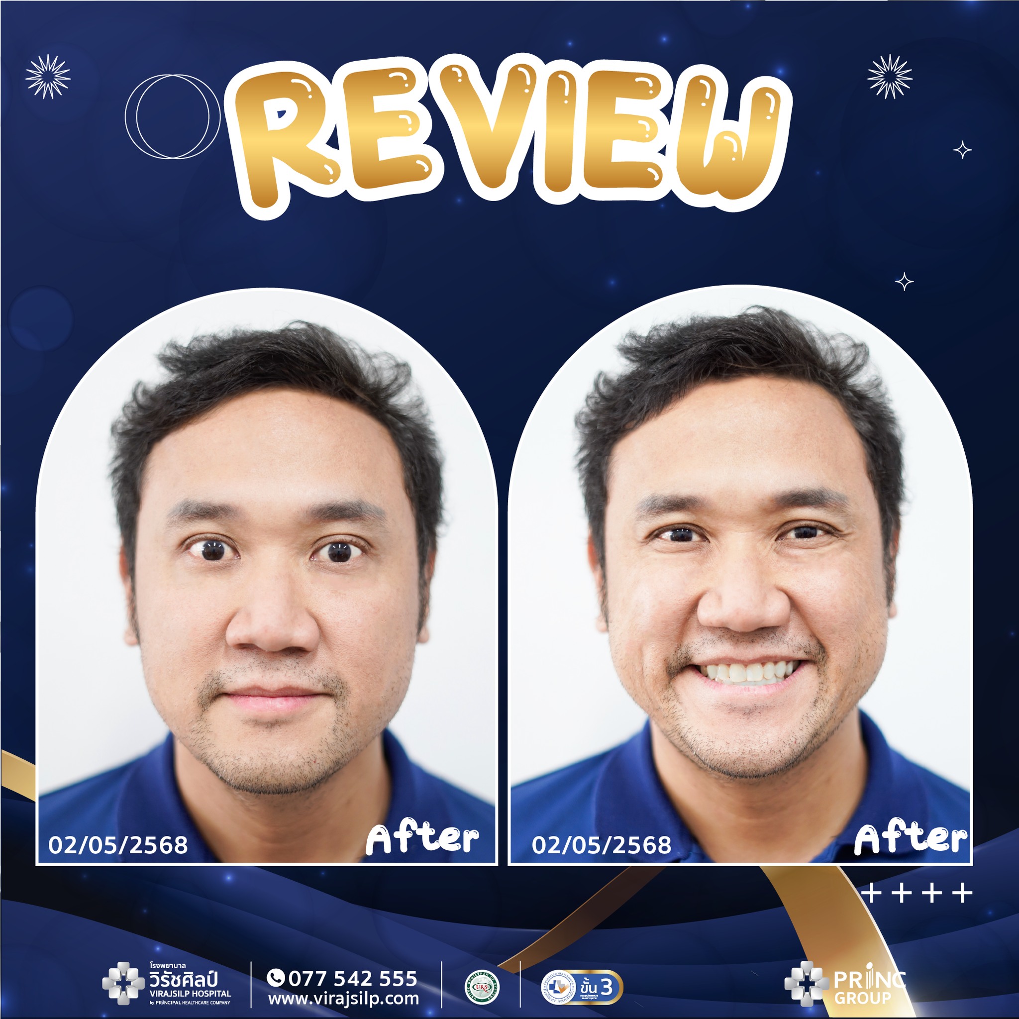 รีวิวการฉีดโบท็อกซ์ (ฺBOTOX) โรงพยาบาลวิรัชศิลป์ จังหวัดชุมพร