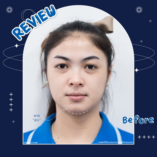 รีวิว Review การฉีดฟิลเลอร์บริเวณคาง จากคุณพราว | โรงพยาบาลวิรัชศิลป์ ชุมพร