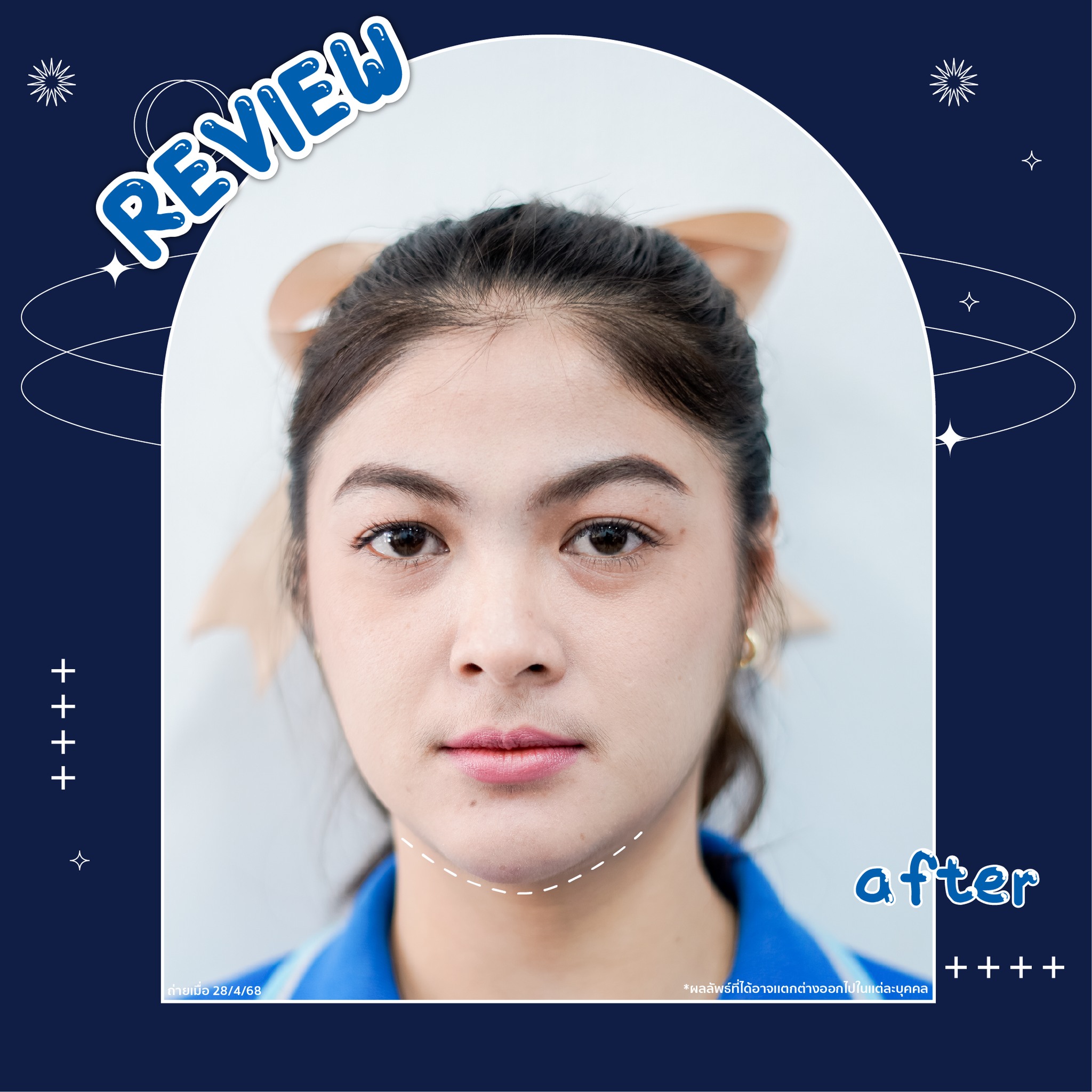 รีวิว Review การฉีดฟิลเลอร์บริเวณคาง จากคุณพราว | โรงพยาบาลวิรัชศิลป์ ชุมพร