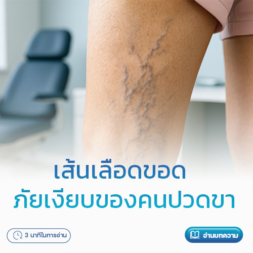 เส้นเลือดขอด ภัยเงียบของคนปวดขา