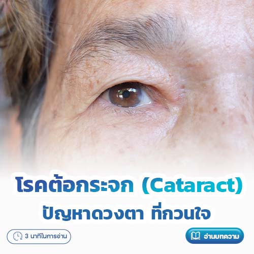 โรคต้อกระจก (Cataract) ปัญหาดวงตา ที่กวนใจ | โรงพยาบาลพริ้นซ์ ลำพูน