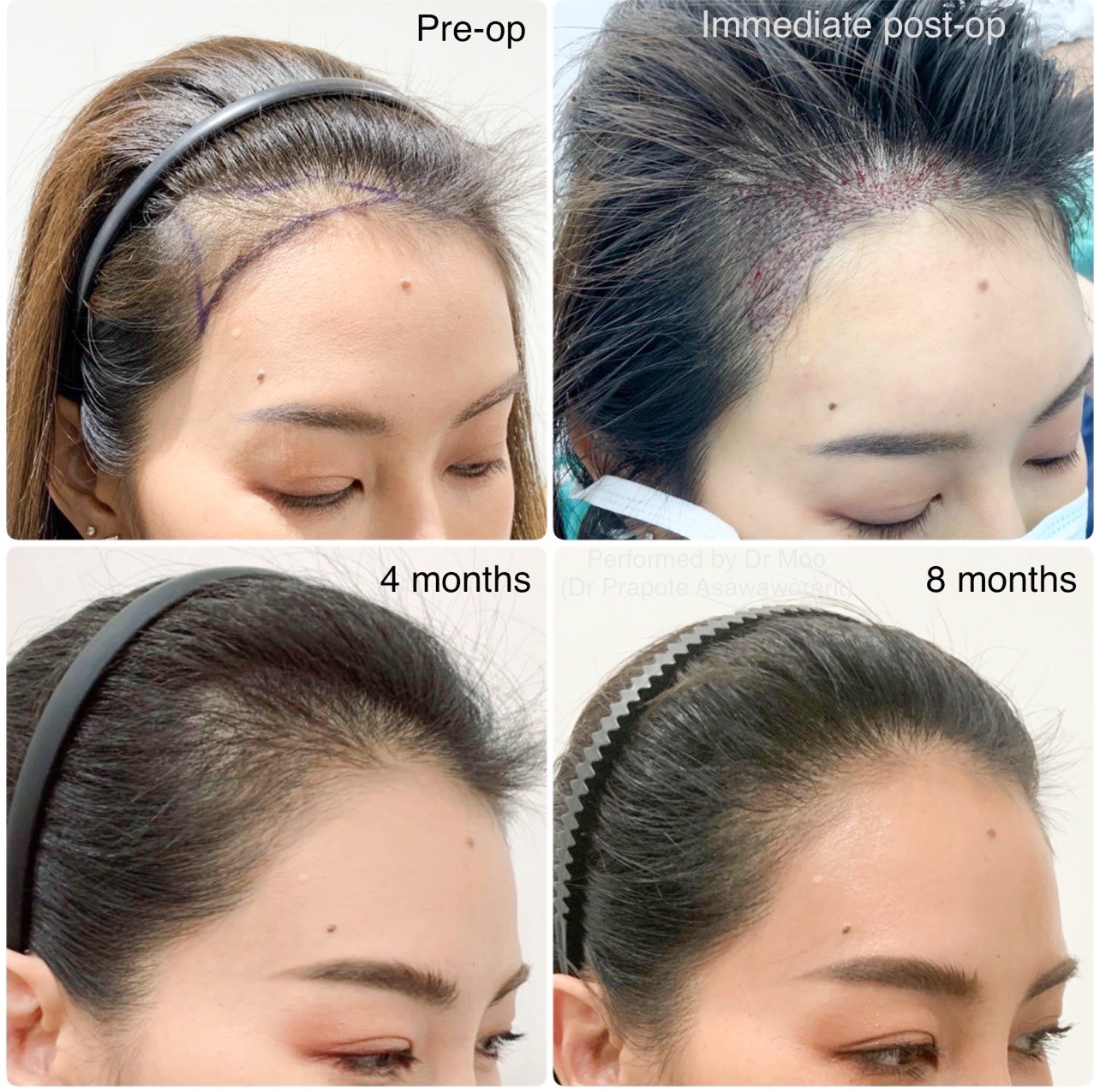 แพทย์ ABHRS กำลังทำศัลยกรรมปลูกผมแบบ FUE ให้กับผู้ป่วย