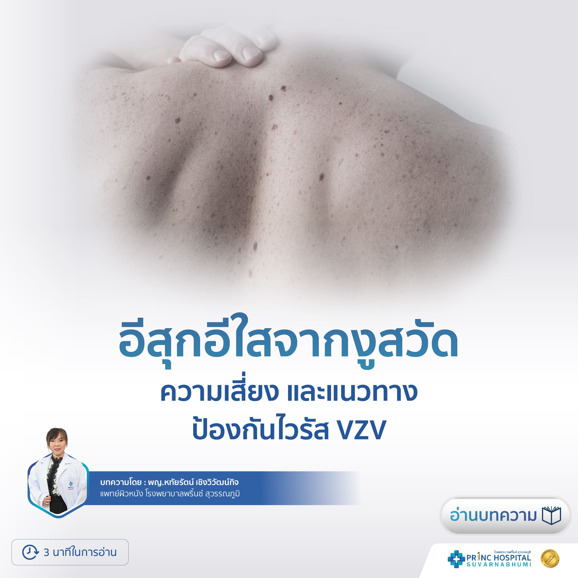 อีสุกอีใสจากงูสวัด: ความเสี่ยงและแนวทางป้องกันไวรัส VZV