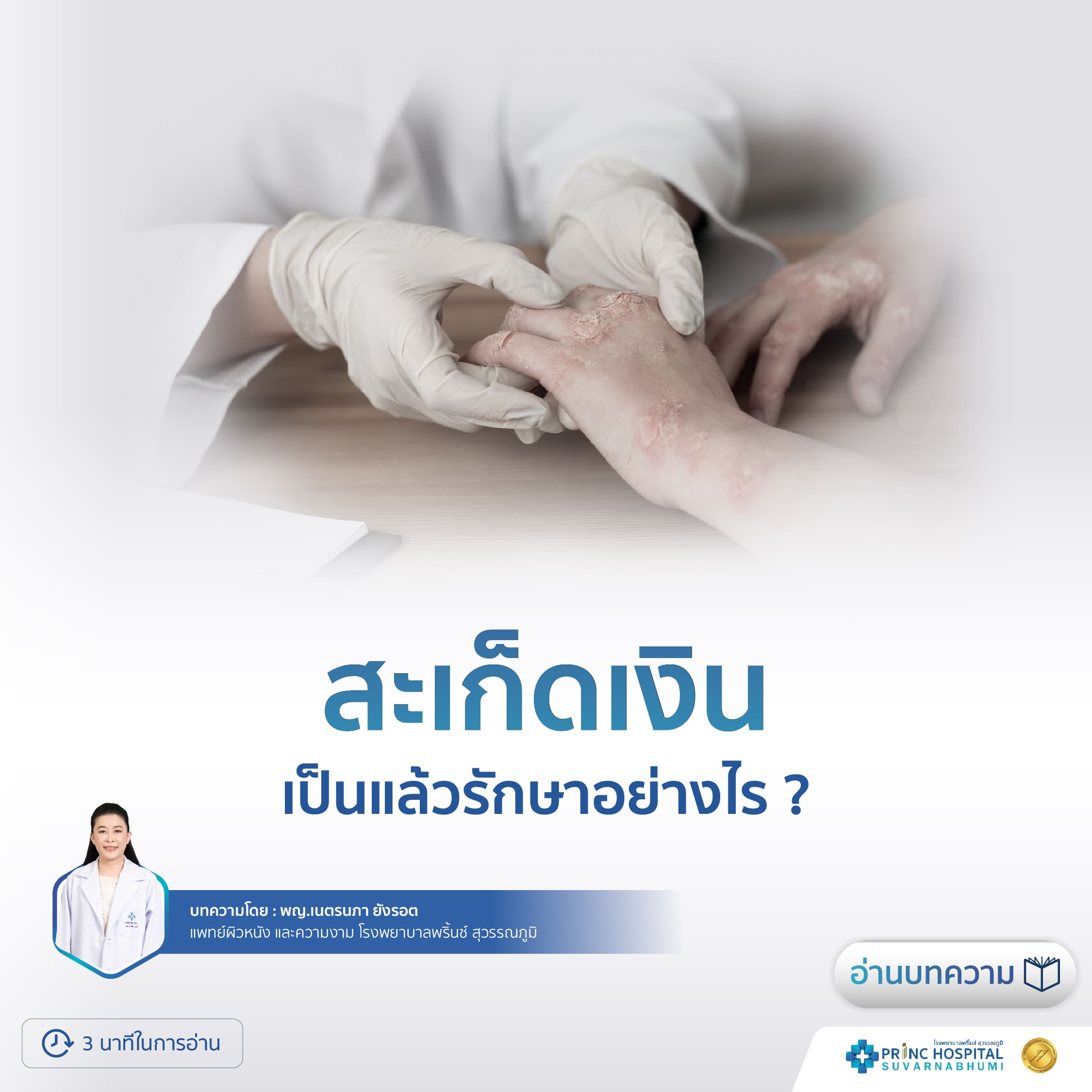 สะเก็ดเงิน เป็นแล้วรักษาอย่างไร?