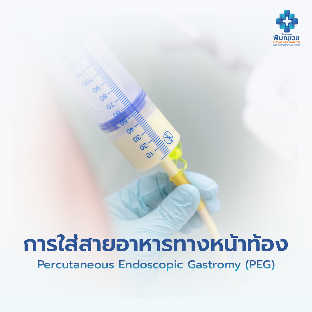 การใส่สายอาหารทางหน้าท้อง