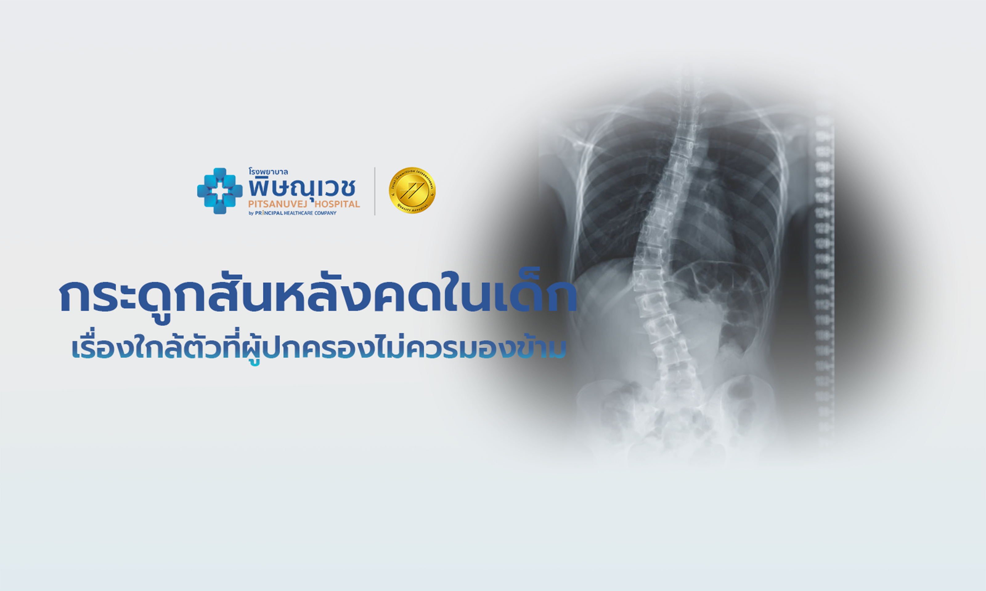 กระดูกสันหลังคดในเด็ก เรื่องใกล้ตัวที่ผู้ปกครองไม่ควรมองข้าม