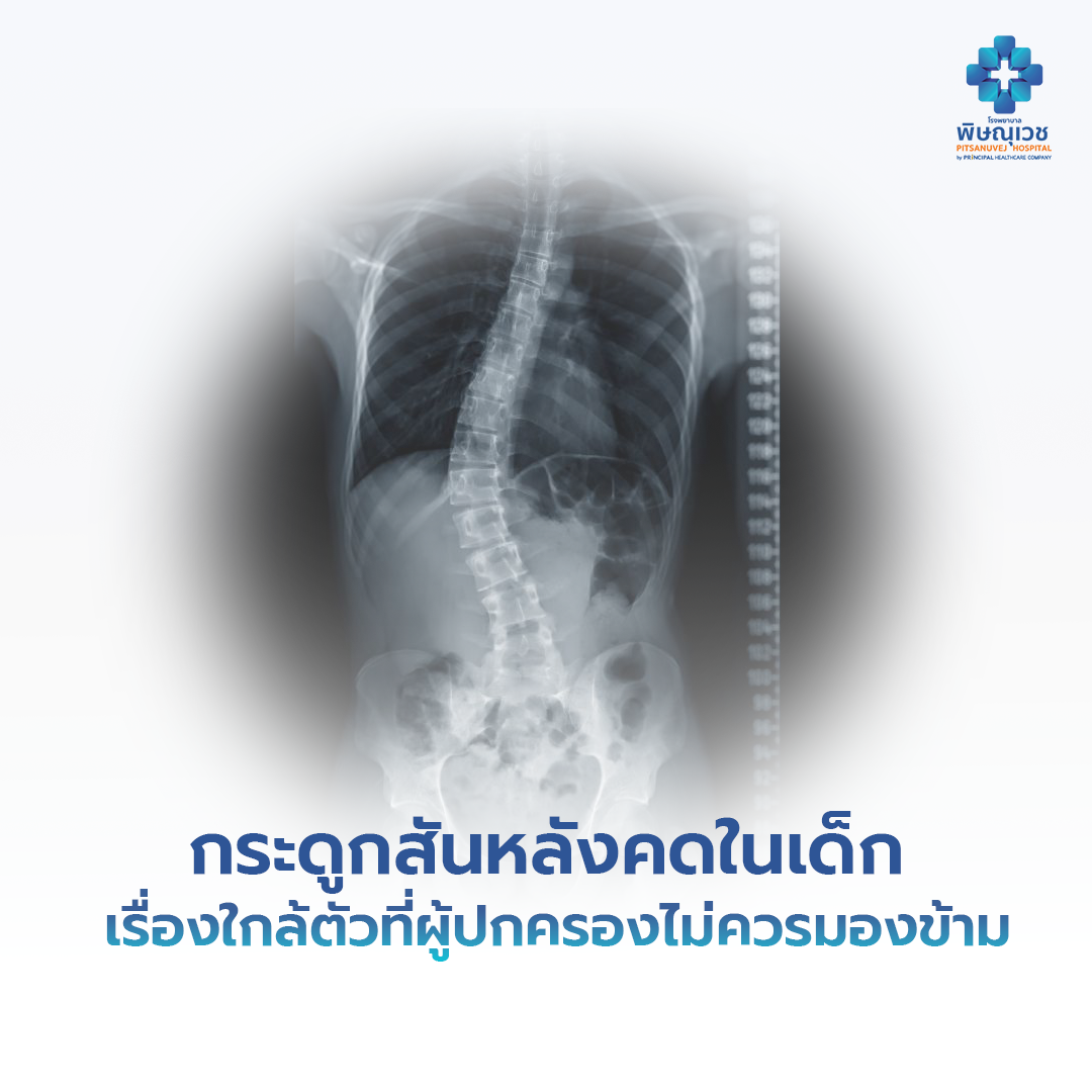 กระดูกสันหลังคดในเด็ก เรื่องใกล้ตัวที่ผู้ปกครองไม่ควรมองข้าม