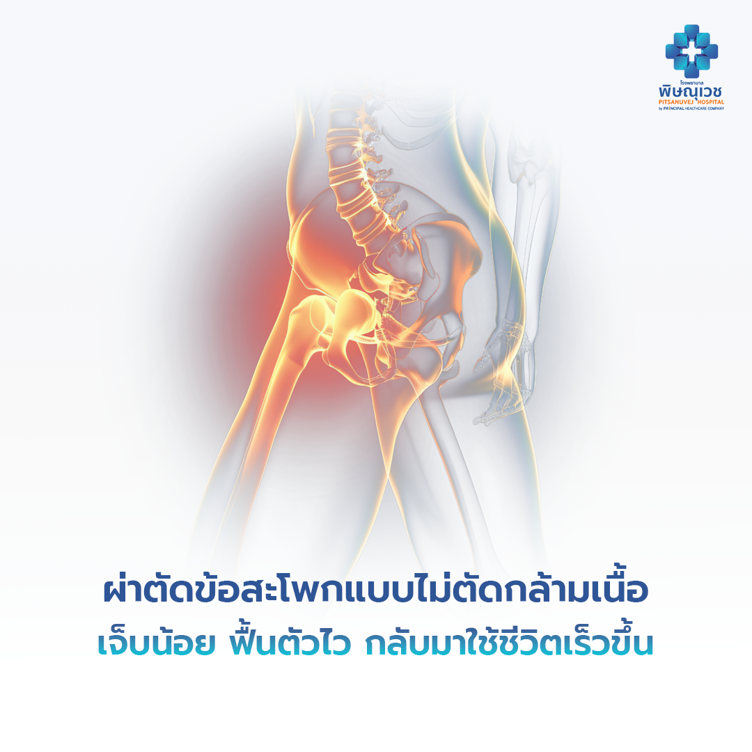 ผ่าตัดข้อสะโพกแบบไม่ตัดกล้ามเนื้อ: ทางเลือกใหม่ที่เจ็บน้อย ฟื้นตัวไว กลับมาใช้ชีวิตปกติได้เร็วขึ้น