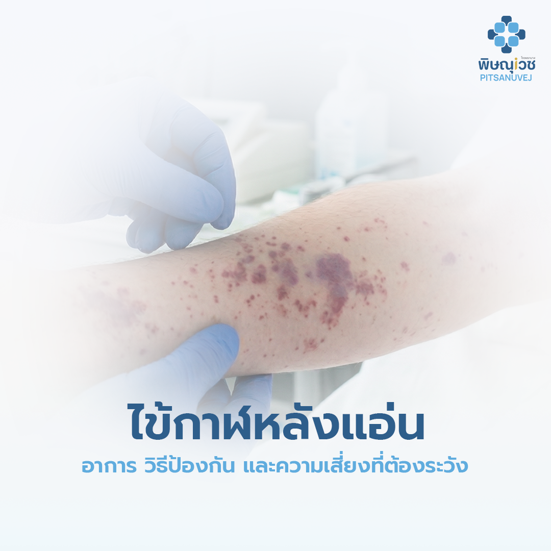 ไข้กาฬหลังแอ่น 2569  เช็กอาการ Red Flags และวิธีป้องกันที่ควรรู้