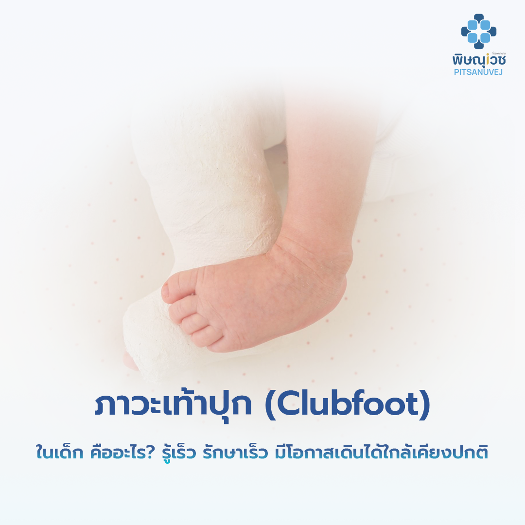 ลักษณะเท้าปุก Clubfoot ในเด็ก เท้าบิดเข้าด้านในและปลายเท้าชี้ลง